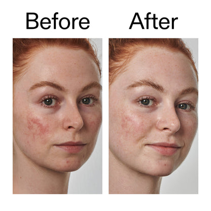 10% Azelaic Acid Serum for Redness Relief